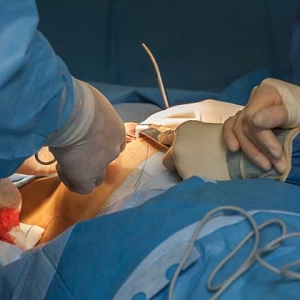 کاتتر آی یو آی